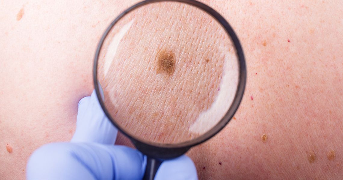 magnifying glass looking at a spot on the skin