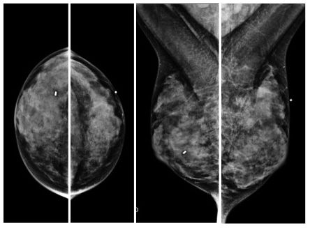 Scanned image of dense mammogram